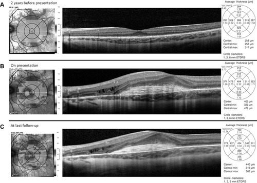 Figure 2 Spectral domain optical coherence tomography horizontal line scan of the left eye prior to development of vision loss, at presentation, and at last follow-up.