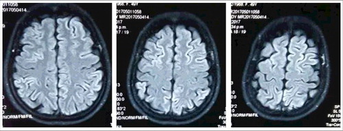 Figure 2. Diffusion weighted imaging (DWI) MRI. High intense signal changes in bilateral frontal, parietal, temporal and occipital cortices.
