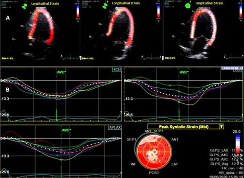 Figure 1 Two-dimensional speckle tracking echocardiography of the left ventricle. (A) Longitudinal strain analysis in the apical 2.3, and 4 chamber views (GLPS); (B). Bull’s-eye summary.
