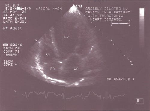 Figure 1 Two-dimensional echocardiogram showing dilated heart chambers – systolic dysfunction.
