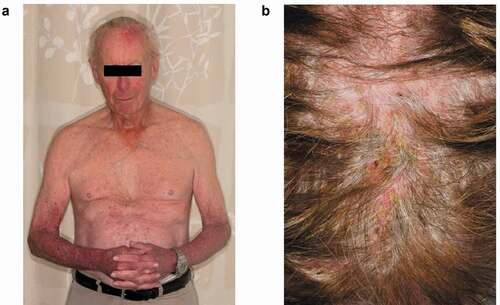 Early Lapatinib-Induced Skin Rash Predicts Better Survival With