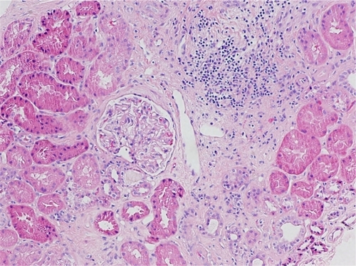 Figure 1 An area of interstitial fibrosis with mild mononuclear cell inflammation. Note the normal glomerulus.