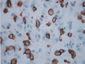 FIG. 2 Immunhistochemical staining for c-kit, showing strong cytoplasmic staining in numerous rhabdoid tumor cells.