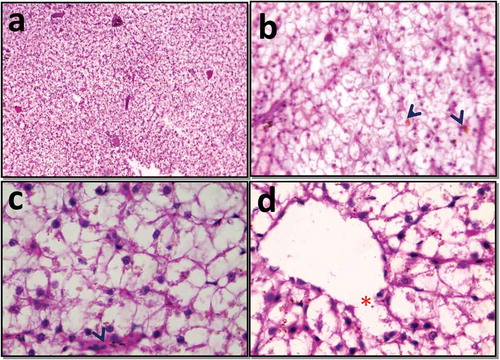 Figure 2. Photomicrograph of histopathological of hepatic tissue after 55 ppb exposure of ABM. (a) Histological damage of liver, 4X; (b) bile stagnation (arrow) and necrosis with gross hepatocellular damage, 10X; (c) Kupffer cell proliferation (arrow), 45X; (d) centrilobular destruction (*) and gross necrosis, 45X)