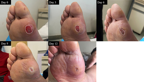 Figure 5 Representative images of the healing process in case 5.