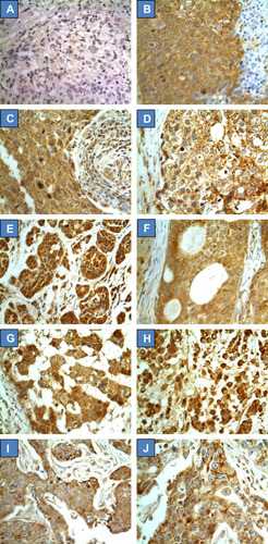 Figure 2 CYP4Z1 expression in different types of TNBC. Tumours were classified on the basis of histological subtype. (A) Normal breast tissue, (B) invasive carcinoma of no special type, (C) medullary carcinoma, (D) invasive lobular carcinoma, (E) mixed ductal and lobular carcinoma, (F) mucinous adenocarcinoma, (G) invasive micropapillary carcinoma, (H) neuroendocrine carcinoma, (I) carcinoid and (J) apocrine carcinoma. Magnification (X400).
