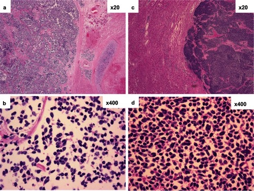 Figure 2 Histology of the primary lung lesion (a: ×20, b: ×400) and metastatic lymph node around the drainage tube (c: ×20, d: ×400).