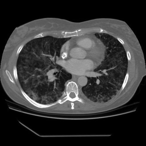 Figure 1. Chest CT scan 9 days after the fourth docetaxel course with widespread interstitial infiltrates.