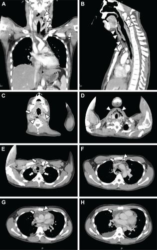 Figure 2 (A) Coronal, (B) sagittal, and (C–H) axial chest CT images on arrival.