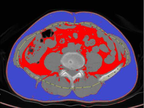 Figure 1. Fat measurements on CT. Subcutaneous fat (SFA, purple area) and Visceral fat (VFA, red area) were segmented after outlines (yellow line) were placed in the abdominal skeletal muscle from the original CT image for automatic calculation
