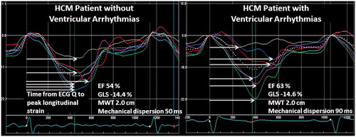 Figure 4. Left panel shows time to peak strain in an HCM patient without ventricular arrhythmias. Mechanical dispersion is 50 ms. Right panel shows time to peak strain in an HCM patient with ventricular arrhythmias. Mechanical dispersion is pronounced with 90 ms. With permission from: Haland et al.[Citation30]