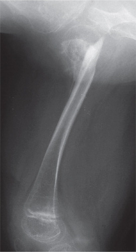 Figure 3. Right hip 3 months postoperatively.