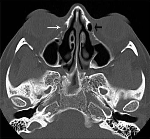 Figure 1 Axial image illustrating a fully opacified (white arrow) and a fully aerated (black arrow) lacrimal sac.