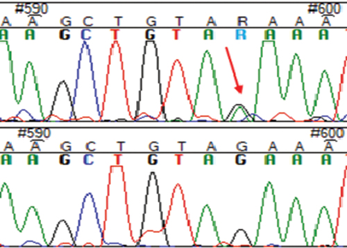Figure 5. Chromatogram showing novel genetic variant c. *34 G>A in IL − 17 F gene (ambiguity code: R).