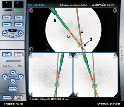 Figure 3. The sterile touch-screen of the navigation system displays navigated instruments in three different projections. The labeled items are (a) the sleeve; (b) the drill bit, including the offset (red) and the potential deviation zone at the tip of the drill bit (green cone); (c) the pointer (green) with offset (red); and (d) the virtual center of the osteochondral lesion.