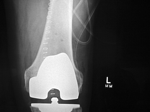 Figure 1. X-ray showing bicortical penetration of the distal femur from a navigation tracking device.