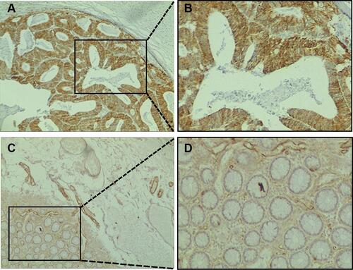 Figure 2 Immunohistochemical staining of SLC7A11 in colon cancer tissues and normal adjacent tissues. (A) Primary cancer tissues magnification 100×. (B) Magnification 400×. (C) Normal adjacent tissues magnification 100×. (D) Magnification 400×.