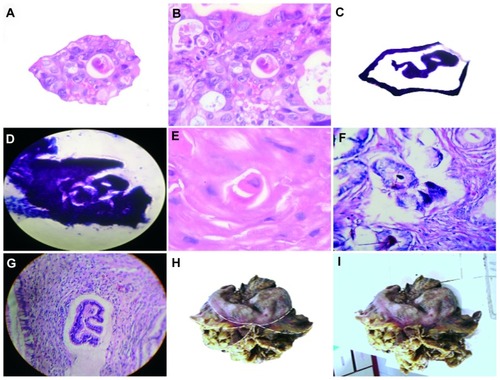 Figure 2 Crystals generate embryoid bodies in the interior of the hexagonal geometry. (A) Detachment subimage of (B) image of embryoid body self-assembly into a geometric triangular chiral hexagonal-like crystal complex in a case of colon adenocarcinoma with hematoxylin and eosin staining (20×). (C) Detachment subimage of (D) image of embryoid body into hexagonal-like crystal complex in a case of lung squamous cell carcinoma with hematoxylin and eosin staining (20×). (E,F) Embryoid body self-assembly in a case of prostate adenocarcinoma with hematoxylin and eosin staining (40×). (G) Well defined embryoid formation in a case of Grade 1 cervical intraepithelial neoplasia with hematoxylin and eosin staining (20×). (H and I) Macroscopic representation of an embryoid body assembled into a geometric hexagonal template platform in a case of gastric adenocarcinoma.