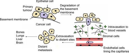 Figure 2 Schematic outline of breast cancer progression.