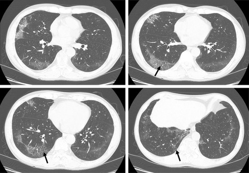Figure 2 A 57-year-old male smoker with pathologically diagnosed DIP.Notes: The axial CT image shows GGO in a subpleural and lower distribution. Thin-walled cysts (black arrows) are seen within the region of the GGOs. Image courtesy of Samsung Medical Center.Abbreviations: CT, computed tomography; DIP, desquamative interstitial pneumonia; GGO, ground-glass opacity.