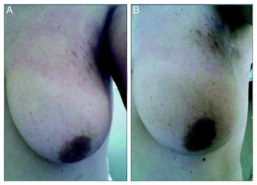 Figure 2. Complete resolution of the skin involvement after chemotherapy.