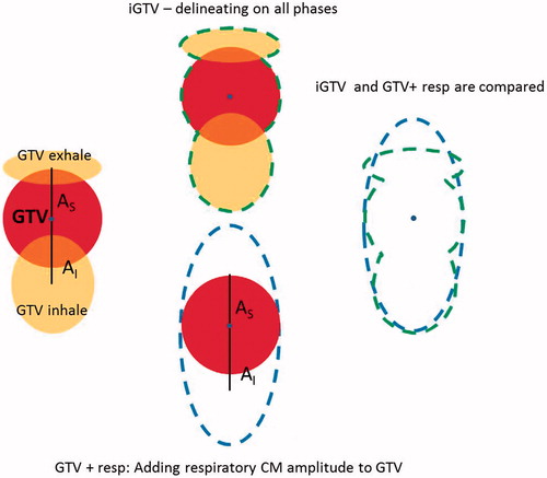 Figure 1. Left: Schematic illustration of deformation of tumor during the respiratory cycle. For simplification only three phases and only S-I motion is shown. All directions of motion were taken into account in the study. Middle: total volume of iGTV and GTV + resp. Right: Overlay of iGTV and GTV + resp, showing regions included in only one of the structures. Centre of mass of the medventilation phase is illustrated by a blue dot.