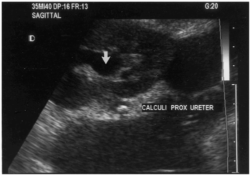 Figure 2. Ultrasound performed five weeks post transplantation for acute deterioration in renal function. Arrow denotes hydronephrotic calyceal system. Stone annotated in proximal ureter.