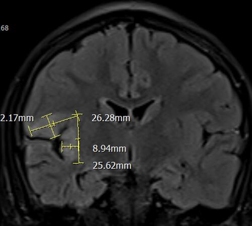 Figure 1 Preoperative magnetic resonance image showing focal cortical dysplasia at the insula, frontal and parietal opercula.