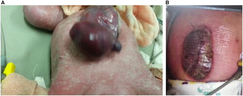 Figure 3. Immediate postnatal images of the newborns of the #cases 3 (A) and 4 (B) showing the complete ectopia cordis.