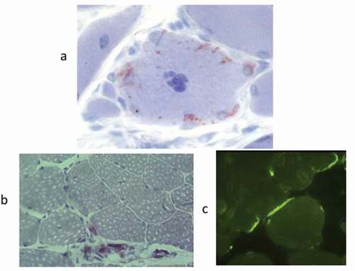 Figure 4. Amyloid deposits within muscle fibers in IBM (a) [modified from [Citation1]]. Amyloid in the connective muscle tissue (b,c) is seen in all kinds of amyloidosis, from neuropathies (b) to systemic (c) and only has diagnostic value [modified from [Citation51,Citation60,Citation61]].