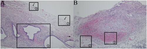Figure 4. (a)Red lesion (HE × 100). (b)Red lesion (HE × 100).Red lesion: The ectopic lesion was located in the subperitoneum, and the glands were mainly large and medium in size, with a dilated glandular cavity and accumulation of peri-glandular stromal cells, as indicated in (a) marker ①; the peritoneal mesothelial tissue structure was destroyed, as indicated in (a) marker ②; interrupted peritoneal mesothelial tissue structure was visible, as indicated in (a) marker ③; and scattered hemorrhage was visible in the subperitoneum, as indicated in (b) marker ①, with abundant microvascular dilatation, as indicated in (b) marker ②.