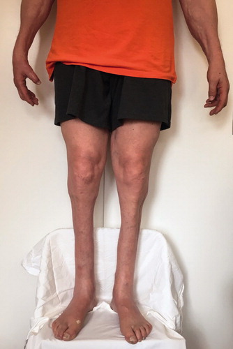 Figure 1. Patient standing at 13 years post-trauma.