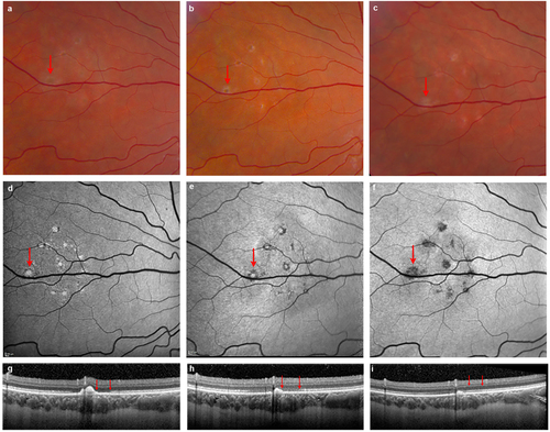 Fig. 1 Posterior lesions in ZIKV-infected patient.a, b, c Fundus photos illustrate the evolution of outer retinal lesions with increasing pigmentation over time. d, e, f Fundus autofluorescence (FAF) images corresponding to outer retinal lesions show hyperautofluorescence at the initial presentation that becomes hypoautofluorescent by 5 months, indicating partial resolution with RPE atrophy. g, h, i Spectral domain OCT confirms the outer retinal location of lesions with nodular hyperreflective elevated spots corresponding to each hyperautofluorescent lesion. The OCT illustrated here represents images across the largest lesion (indicated by arrow on FAF, Fig. 1d). One and 5 months after onset there is spontaneous partial reconstitution of outer retina with resolution of some lesions, whereas some lesions result in atrophy. Note that the outer retina immediately adjacent to the largest lesion shows reconstitution of the ellipsoid zone by 5 months concurrently with the resolution of the nodular elevation on OCT (two red arrows). Note that images corresponding to onset and 1 month follow-up correspond to a previously reported patientCitation6 and are provided here as reference for month 5