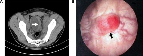 Figure 1 The images of CT and cystoscopy in a patient with ALK-positive ALCL involving the urinary bladder.