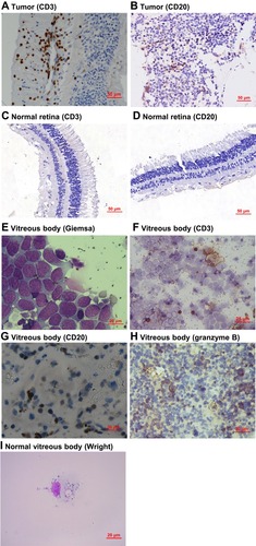 Figure 3 The blood-retinal barrier is disrupted by retinoblastoma. (A–D) Representative immunohistochemical images of CD3 and CD20 in retinoblastoma and normal retina tissues. (E–I) Representative images of vitreous bodies from retinoblastoma patients without vitreous hemorrhage. The images of Giemsa staining (E), CD3 staining (F), CD20 staining (G), granzyme B staining (H), and the normal vitreous control (I) were taken at different magnifications as indicated.
