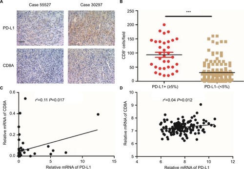 Figure 3 Immunohistochemical staining of human ICC tissues using anti-PD-L1 and CD8 monoclonal antibody.Notes: (A) ICC tissue sections were analyzed by IHC for PD-L1 expression on tumor cells and CD8+ T-cell infiltration. PD-L1 positivity was defined as ≥5%, and the number of CD8+ T-cells was assessed in five distinct microscopic fields (×200). (B) Tumors were classified as PD-L1+ (≥5%) and PD-L1− (<5%) and analyzed for the amount of CD8 (P-value<0.001). (C) Correlation studies were performed for PD-L1 and CD8A in 54 ICC tissues by linear regression. β-Actin was used as an internal control. r: Spearman’s correlation coefficient. (D) Correlation studies were performed for PD-L1 and CD8A in the 149 ICC patients from National Center for Biotechnology Information Gene Expression Omnibus database (GSE33327) by linear regression. r: Spearman’s correlation coefficient.Abbreviations: ICC, intrahepatic cholangiocarcinoma; IHC, immunohistochemistry; PD-L1, programmed death ligand 1.