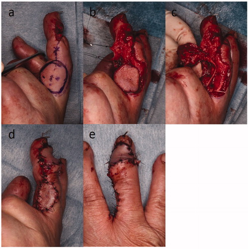Figure 2. (a–e) Reversed digital artery flap reconstruction was performed.