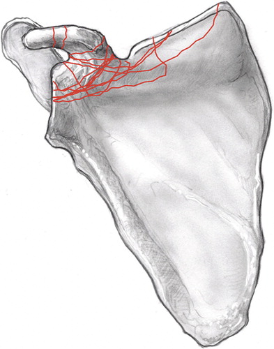 Figure 1. AP illustration of the scapula showing the 14 coracoid fracture patterns seen in this cohort. The patterns together yield the “coracoid fracture map.”