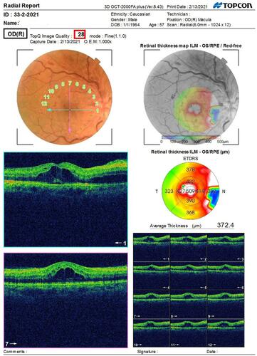 Figure 1 Male patients 57 years old. He came to the ophthalmology clinic 1 months after recovery from COVID-19 infection, complaining of sudden diminution of vision. His optic disc was swollen and edematous with engorged vessels. His macular OCT scans show cystoid macular edema (CME) continuous with the disc edema with presence of neurosensory detachment (NSD).