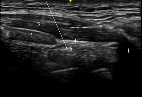 Figure 2 The view of ultrasound-guided superior laryngeal nerve block. Hyoid bone, 1; thyroid cartilage, 2; thyrohyoid muscle, 3; thyrohyoid membrane, 4; superior laryngeal nerve, 5; the arrow denotes the puncture path of the needle.