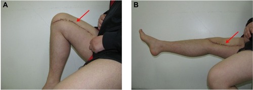 Figure 3 Good knee function after surgery.