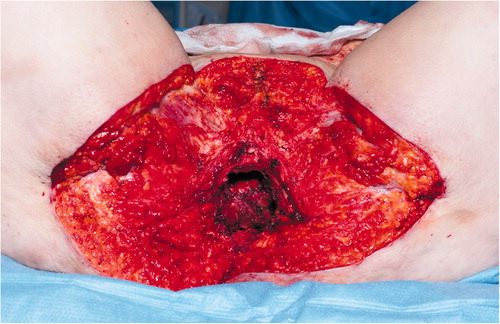 Figure 2. Perineal defect post-resection.