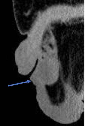 Figure 1 Computed tomography revealed an abscess with a diameter of 5 cm in the scrotum without gas image (sagittal section).