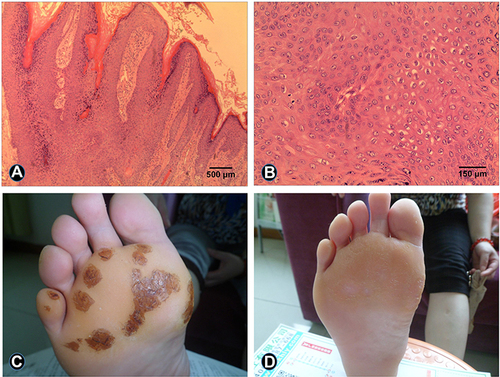 Figure 1 Histopathology examination before and after treatment with cantharidin cream in patients with Verruca plantaris. Patients with Verruca plantaris completed 4 weeks of treatment. (A) The histopathological examination demonstrated parakeratosis and papillomatous hyperplasia of the epidermis (hematoxylin-eosin stain, magnification 100×). (B) The histopathological examination revealed a large number of vacuolated cells in the epidermis (hematoxylin-eosin stain, magnification 400×). (C) Several neoplasms detected on the foot prior to the treatment. (D) The foot lesions were eliminated post treatment.