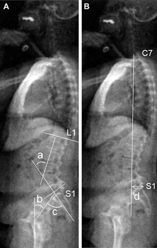 Figure 1 Parameters measured on lateral radiographs of the whole spine and pelvis (A) angular parameters (°); a) lumbar lordosis; the Cobb angle from the upper endplate of L1 to the lower endplate of S1, b) pelvic tilt, the angle between the line connecting the midpoint of the sacral plate to the axis of the femoral heads and the vertical axis; c) pelvic incidence; the angle between the line perpendicular to the sacral plate at its midpoint and the line connecting this point to the axis of the femoral heads. (B) Linear parameter (mm); d) sagittal vertical axis; horizontal distance from the C7 plumb line originating at the middle of the C7 vertebral body to the posterior superior endplate of S1.