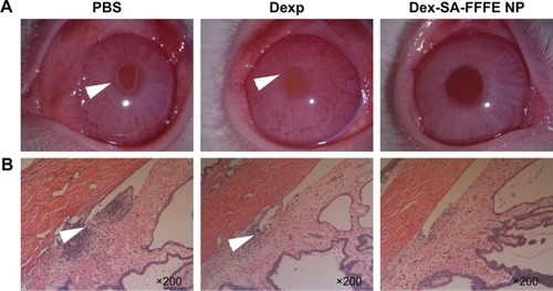 Figure 6 (A) Clinical signs of anterior uveitis in rabbits treated with PBS, Dexp, and Dex-SA-FFFE nanoparticles. White arrowheads indicate inflammatory exudates in the anterior chamber. (B) H&E sections of rabbit eyes treated with PBS, Dexp, and Dex-SA-FFFE nanoparticles at 24 hours after challenge with LPS. White arrowheads indicate inflammatory cells infiltration in the anterior chamber.Abbreviations: Dex-SA-FFFE, dexamethasone-peptide conjugate; Dexp, Dex sodium phosphate; H&E, hematoxylin and eosin; LPS, lipopolysaccharide.