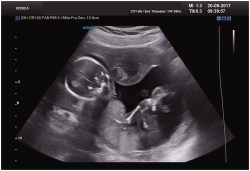 Figure 4. Viable fetus in the uterine cavity – 24th week of the pregnancy. Uterine fibroid located in the anterior wall.