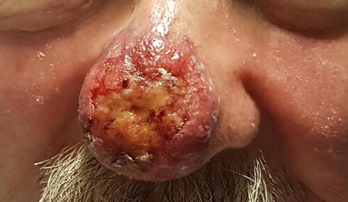 Figure 1 Exophytic erythematous lesion on the tip of the nose with telangiectasia and central ulceration.