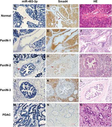Figure 1 miR-483-3p expression by LNA-ISH and SMAD4 protein expression by immunohistochemistry in PanIN lesions and PDAC tissues. (A) Expression of miR-483-3p was detected in the cytoplasm of normal pancreatic acini but not in normal pancreatic ducts. An increase in staining intensity for miR-483-3p was observed across the progression of normal pancreatic ducts to PanIN-1 (D), PanIN-2 (G), PanIN-3 (J) and PDAC (M) lesions. Protein expression of the putative miR-483-3p target gene SMAD4 was detected in normal pancreatic acini and ducts (B), as well as PanIN-1 (E) and PanIN-2 (H) lesions, but decreased in PanIN-3 (K) and PDAC (N) lesions. (C, F, I, L, O) Hematoxylin and eosin (HE) staining for normal pancreas (C), PanIN-1 (F), PanIN-2 (I), PanIN-3 (L) and PDAC (O).