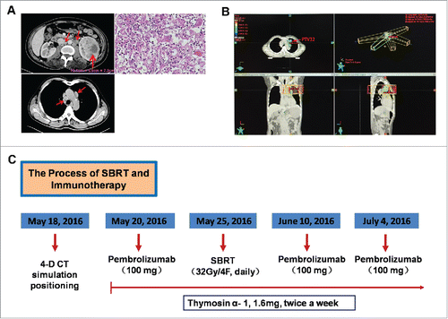 Figure 1. The diagnosis imaging of renal cell carcinoma and the whole process of treatment. A. CT scan before nephrectomy treatment (February 23, 2016); H&E staining of tumor tissue showed a clear cell renal carcinoma. B. The para-aortic enlarged mass was selected as RT target and an additional 0.5 cm margin was added to create a planning target volume (PTV); a total of 32 Gy was administered in 4 fractions to PTV with 6-MV photons by means of a coplanar 5-field intensity-modulated, image-guided technique. C. The whole process of treatment with the concurrent RT and pembrolizumab.